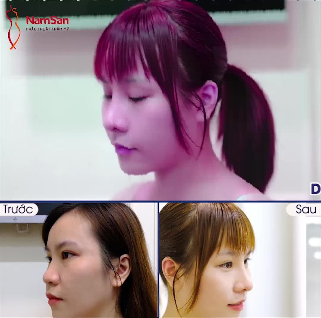 NÂNG MŨI CHO "MỊ" KỊP ĐẸP ĂN TẾT