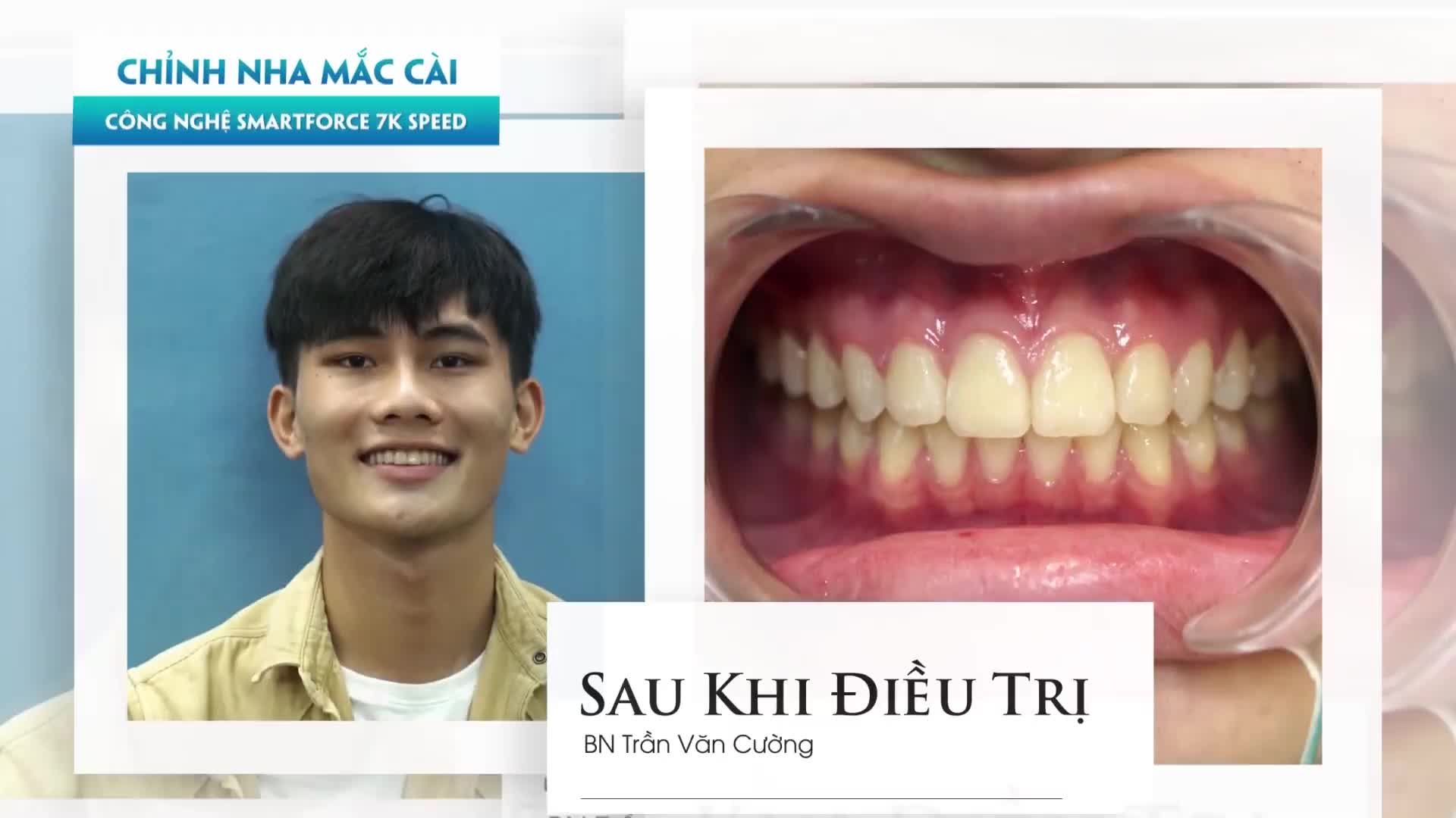 "Niềng răng em thấy không có gì đáng sợ hay đau, thậm chí bác sỹ thông báo lịch tháo mắc cài em còn lần lữa vì em đã quen với việc đeo mắc cài rồi."