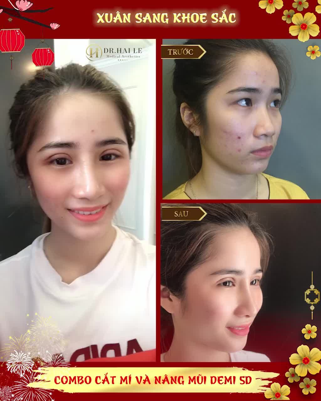 SẮC DIỆN GƯƠNG MẶT HOÀN TOÀN THAY ĐỔI nhờ Combo Cắt mí  Nâng mũi tại Dr.Hải Lê!