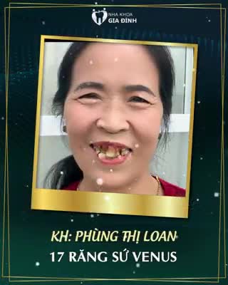 2 NGÀY LÀM RĂNG - 1 NĂM NGỜI SÁNG