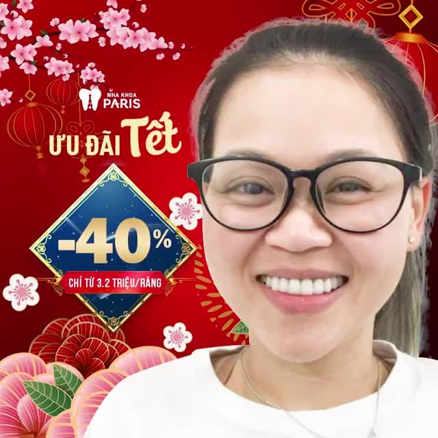 Điều trị răng khấp khểnh, nhiễm màu - Với Bọc Răng Sứ Nano 5S