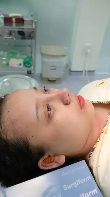 MŨI CẤU TRÚC SỤN SURGIFORM VỪA THỰC HIỆN XONG