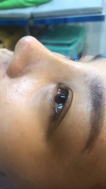Nâng Mũi Bán Cấu Trúc Đa Lớp