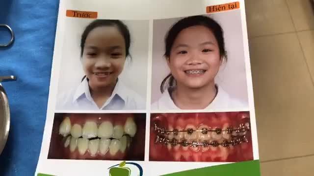 Tháo mắc cài tại Nha Khoa Thuỳ Anh.