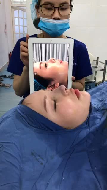 SỬA MŨI HỎNG ĐẸP NGAY TRÊN BÀN PHẪU THUẬT !