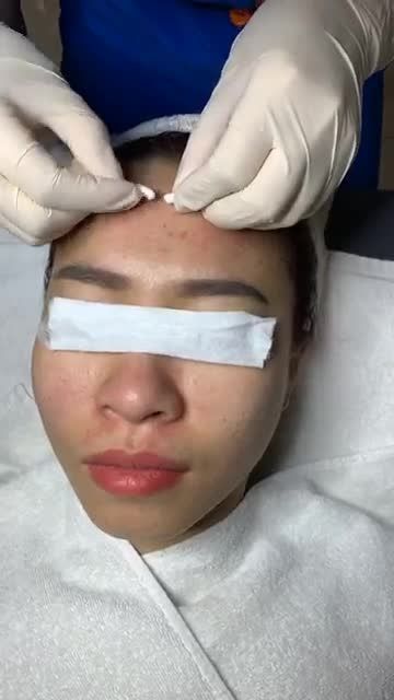 Quét sạch mụn ẩn dưới da, mụn đầu đen trong vòng 1 nốt nhạc với công nghệ Nano skin