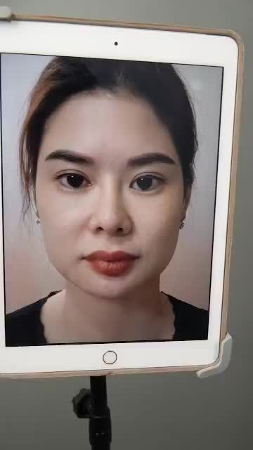 TÁI KHÁM SAU 10 NGÀY NÂNG MŨI SỬA LẠI