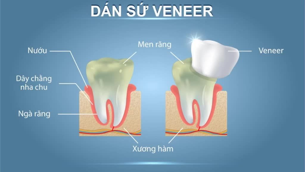 DÁN SỨ VENEER BẢO TỒN RĂNG THẬT BỌC KÍN RĂNG THƯA SỨ SIÊU MỎNG SIÊU BỀN CHẮC GIẢM 30% CHỈ CÒN 4TR/RĂNG (̶G̶̶I̶̶Á̶ ̶G̶̶Ố̶̶C̶ ̶6̶̶T̶̶R̶)
