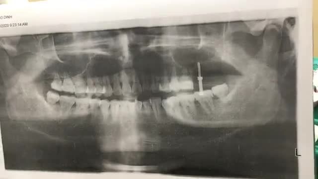 Cấy implant vị trí 27 cho khách hàng dịp cuối năm tại Nha Khoa Thuỳ Anh.