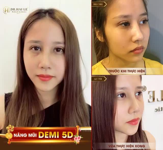 Mũi cao thanh thoát vào dáng mềm mại ngay sau 10 ngày. Nâng mũi hôm nay, tự tin đón Tết!