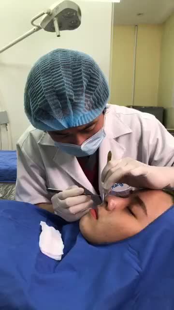 Qui trình cắt chỉ Nâng mũi cấu trúc 4D sau 10 ngày