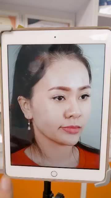 GẶP LẠI HOTGIRL CỦA VIỆN SAU 20 NGÀY NÂNG MŨI HOÀN THIỆN NHAN SẮC