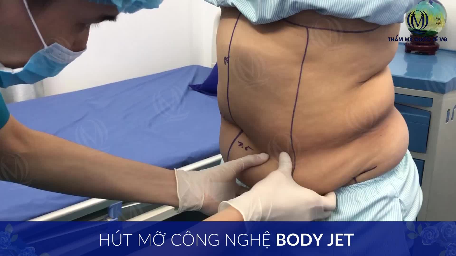 HÚT MỠ TẠO HÌNH BỤNG DR Vũ Quang