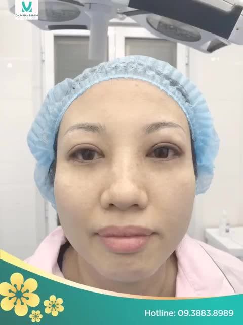 XUÂN CANH TÍ TẠM BIỆT MẮT MỘT MÍ, MÍ HỎNG, SỤP MÍ