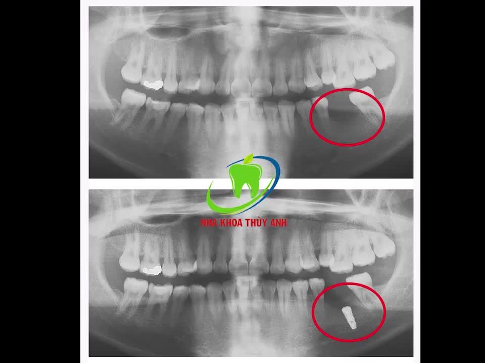 BẤT NGỜ VỀ PHƯƠNG PHÁP CẤY GHÉP IMPLANT TẠI NHA KHOA THUỲ ANH