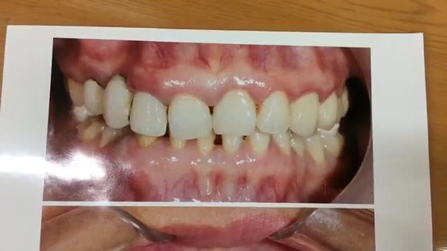 Lắp răng sứ thẩm mỹ cho cô Ngọc tại Nha Khoa Thùy Anh.