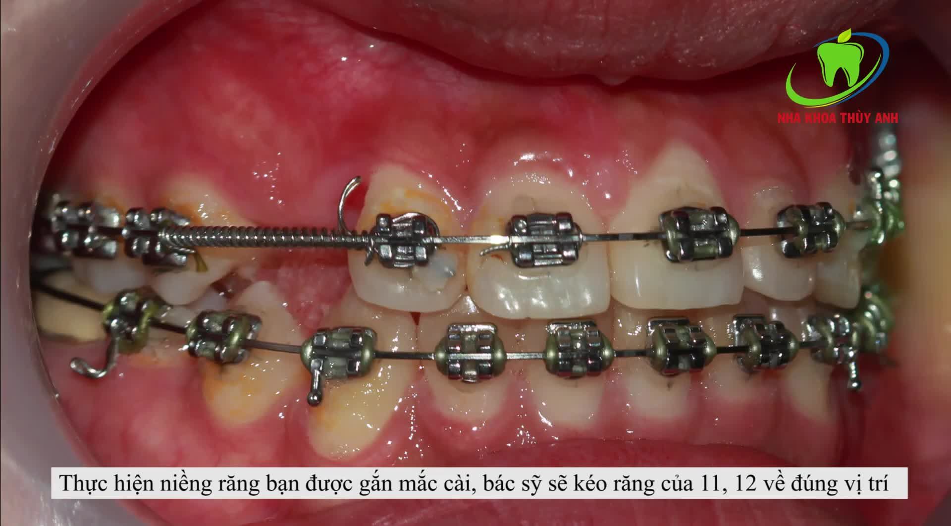 NIỀNG RĂNG - KÉO RĂNG NGẦM TÌM LẠI NỤ CƯỜI VỐN CÓ