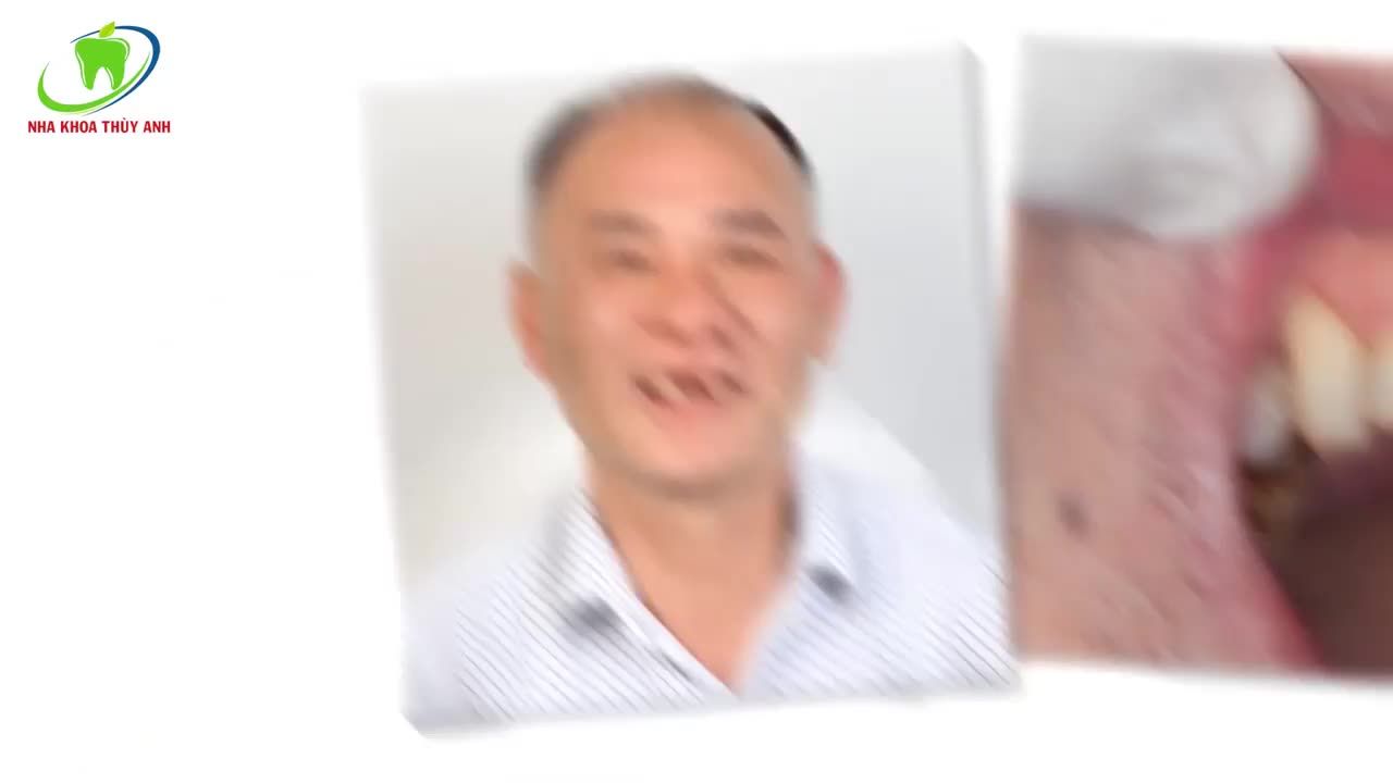 IMPLANT GIẢI PHÁP HOÀN HẢO CHO NGƯỜI MẤT RĂNG