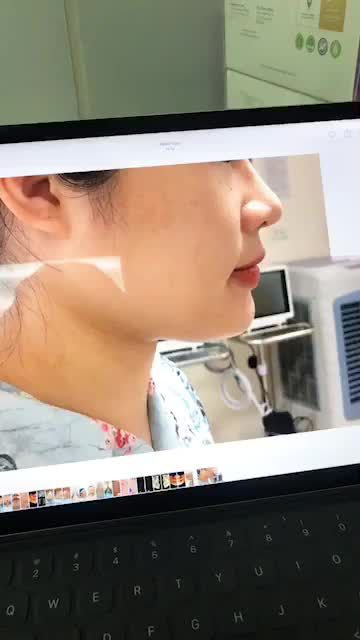 Kết quả ca gọt hàm số 2 năm 2020 của Dr. Hoàng Tuấn Phẫu thuật được thực hiện tại bệnh viện theo đúng quy định của Bộ Y Tế