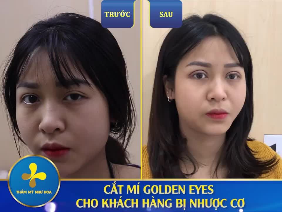 MẮT NHƯỢC CƠ KHÔNG CÒN LÀ VẤN ĐỀ NHỜ CẮT MÍ GOLDEN EYES
