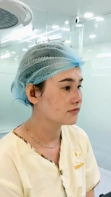 NÂNG MŨI CẤU TRÚC SỬA LẠI VỪA THỰC HIỆN XONG