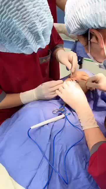 Quá trình cắt Cuộn cánh mũi tại bvtm Kangnam