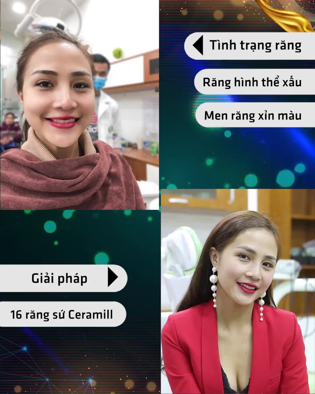 TÁI SINH NỤ CƯỜI VỚI RĂNG SỨ E.MAX THỦY TINH CAO CẤP ĐỨC