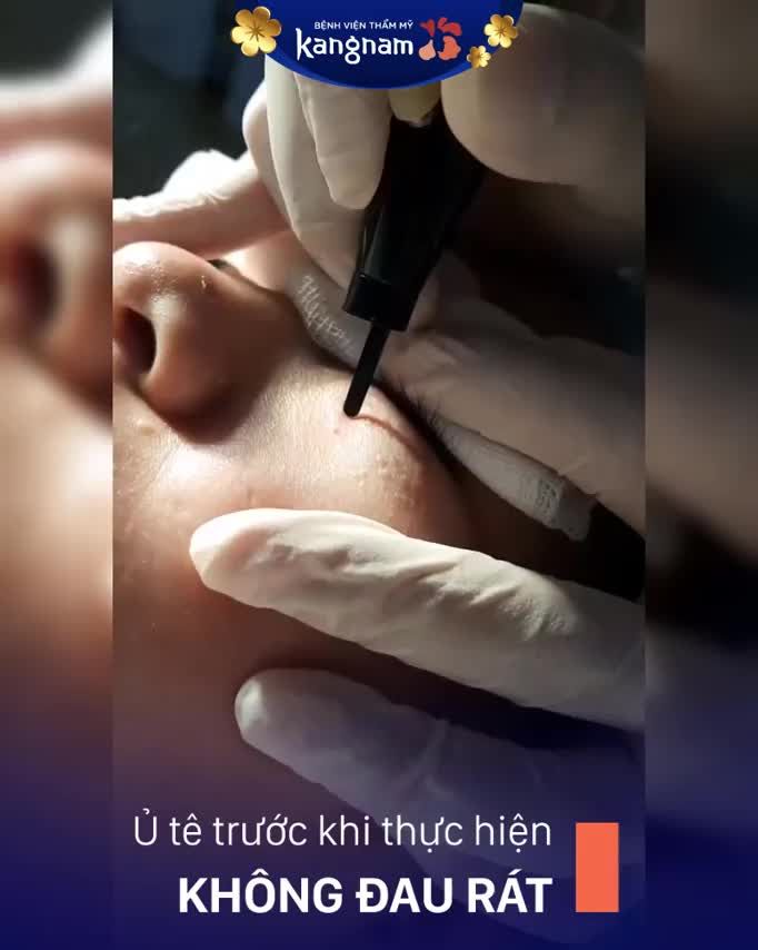 Sạch bay MỤN THỊT Với 40 PHÚT thực hiện
