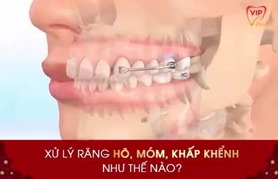 Niềng răng giúp đưa hàm răng khấp khểnh về đúng vị trí, mang lại hàm răng đều tăm tắp mà không cần phải nhổ răng - Đến ngay Vip Dentist