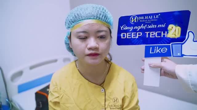 Sửa mí DEEP TECH20 - "Phù phép" đôi mắt xấu hỏng thành mắt 2 mí lung linh mọi góc nhìn!