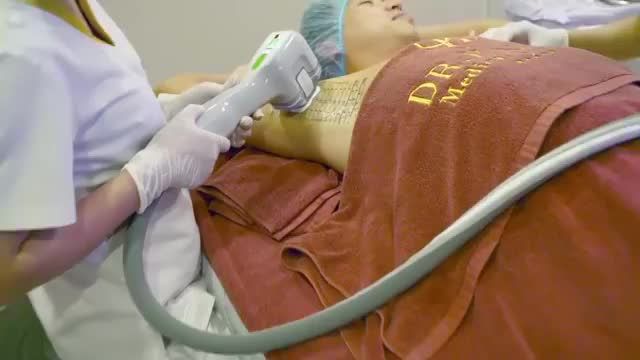 CÙNG XEM QUY TRÌNH ĐIỀU TRỊ CHỨNG TĂNG TIẾT MỒ HÔI NÁCH DOUBLE MIRADRY.