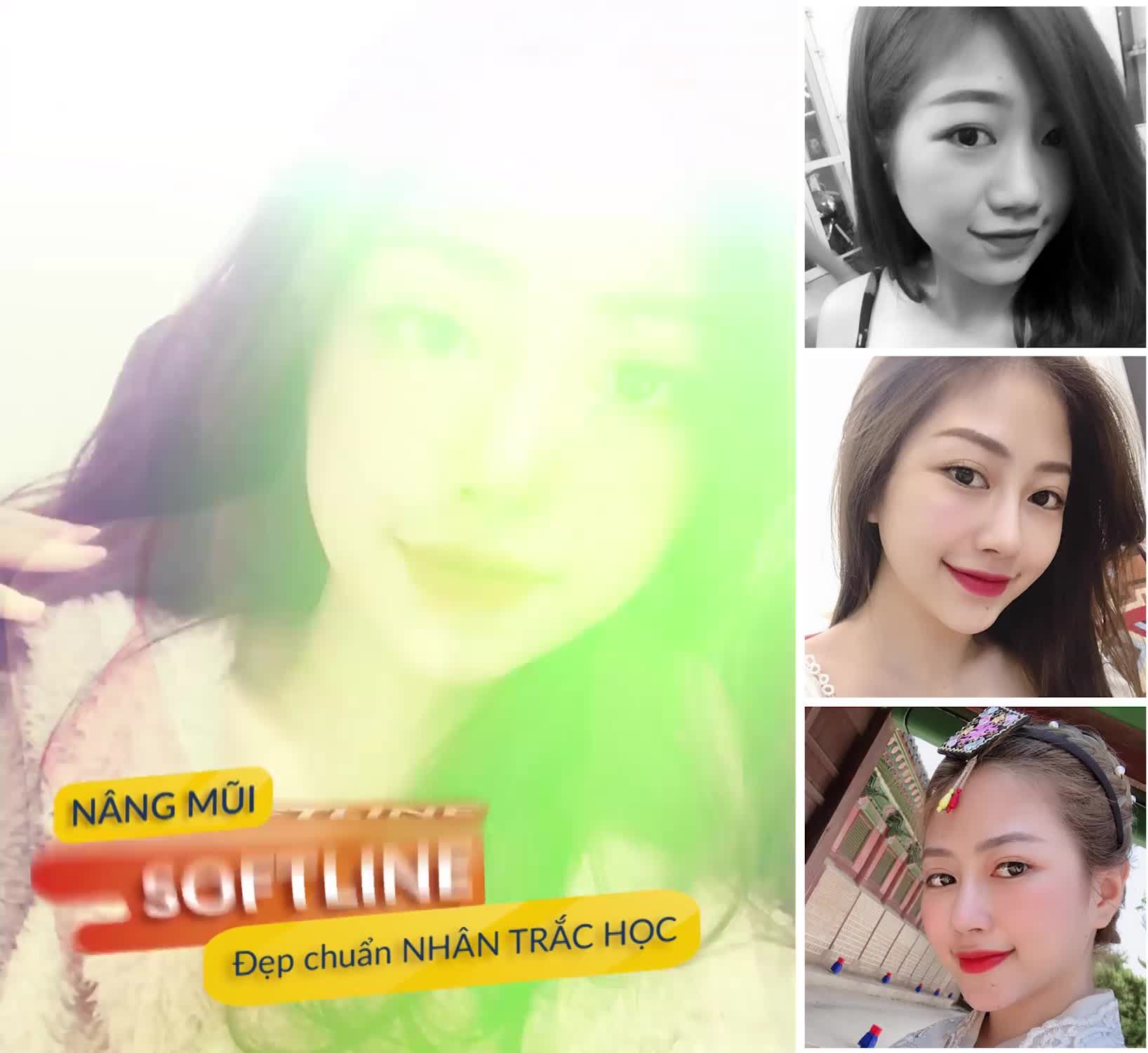 Nâng mũi SOFTLINE - mũi cao sang chiêu tài lộc chỉ 13.999k