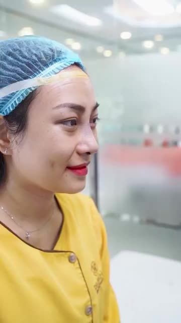 Kết quả sau khi NÂNG MŨI MEDI FORM - dáng mũi cao tư nhiên, hài hòa với khuôn mặt, đem lại cho bạn góc nghiêng "vạn người mê"!