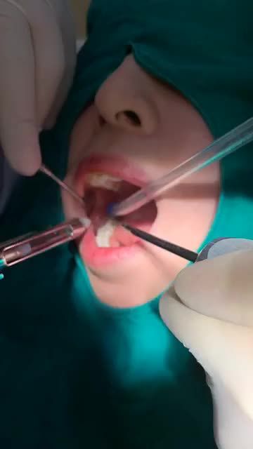 Nhổ răng khôn 48 siêu cong bằng máy siêu âm. Khách hàng: Minh tú  Sài Gòn