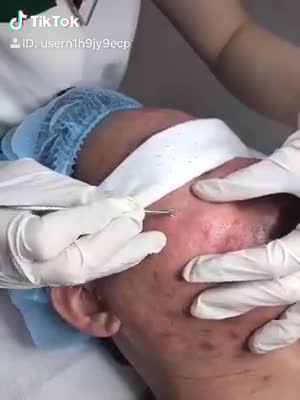 Cận cảnh quá trình điều trị mụn không sẹo công nghệ Acne Plus tại bệnh viện thẩm mỹ Đông Á