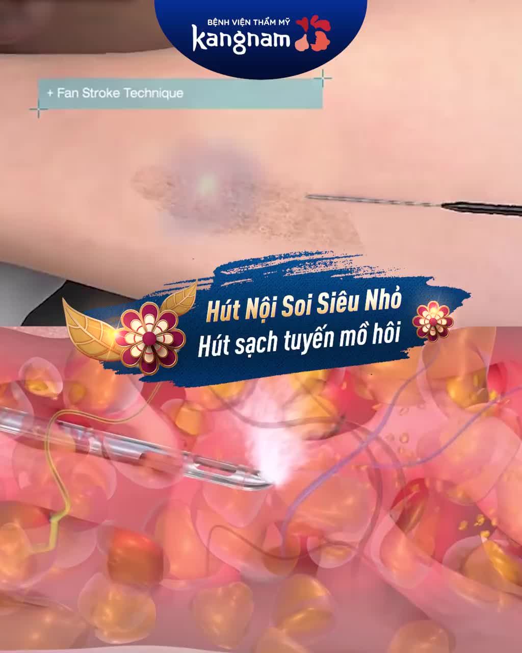 40 Phút cùng Endo Dry "say Bye" Hôi Nách