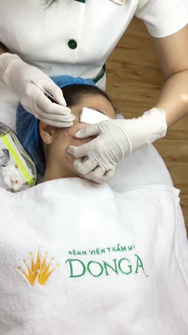 Mụn viêm, mụn mủ do chăm sóc da không đúng cách