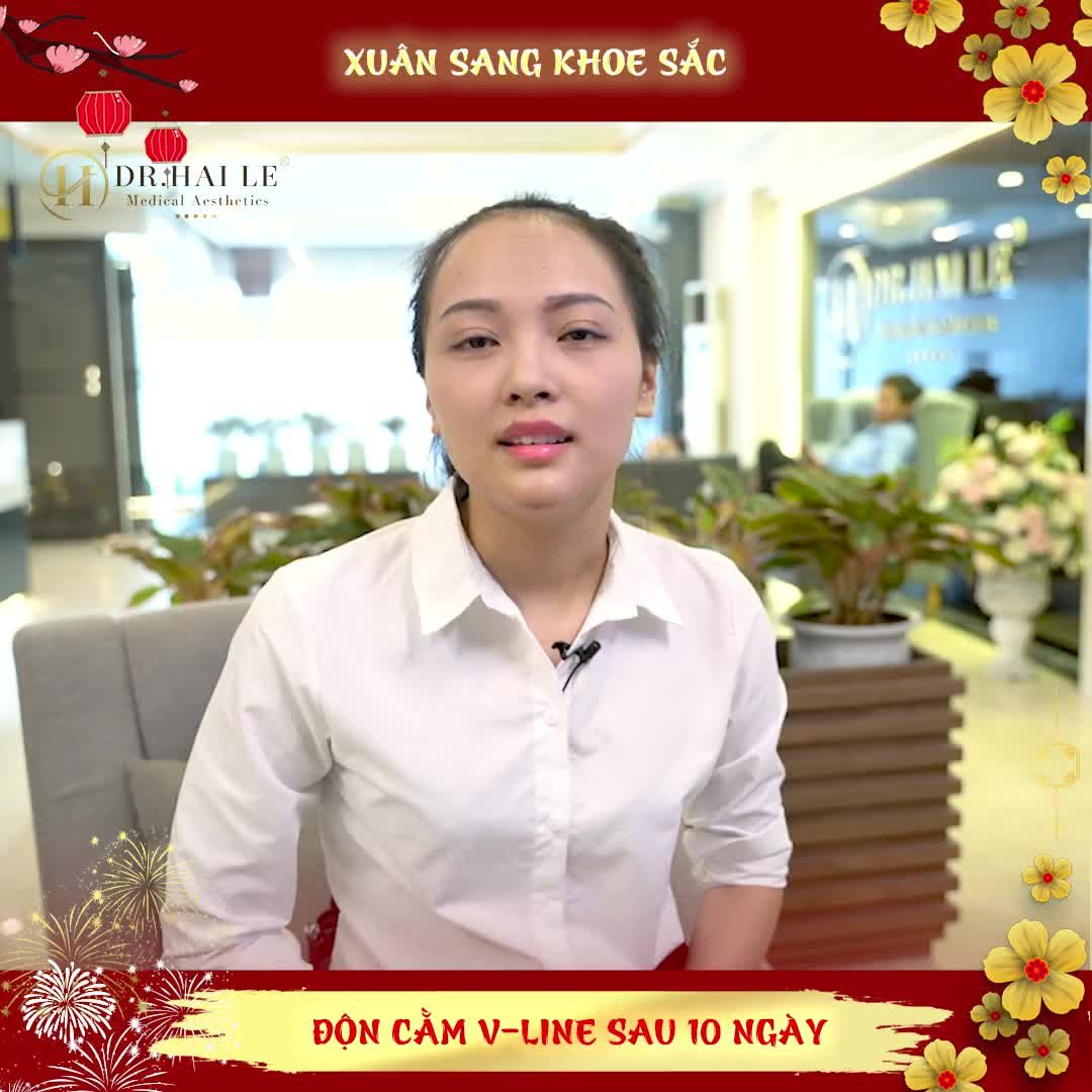 KẾT QUẢ ĐỘN CẰM V-LINE SAU 10 NGÀY TẠI DR.HẢI LÊ!