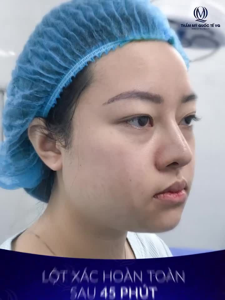 Tạm biệt mũi thấp, gồ, đầu mũi tròn to thô chỉ sau 45 phút