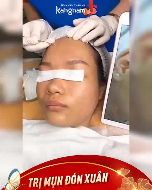 Sạch mụn - Kịp đón Tết - Chỉ 99K