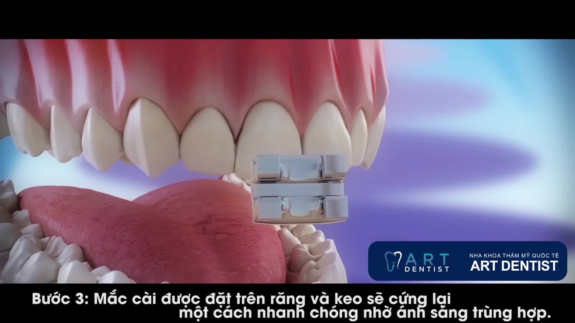 Quá trình gắn mắc cài 4 bước của Nha khoa