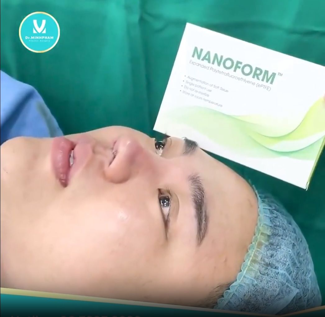 3 LOẠI CHẤT LIỆU NÂNG MŨI ĐƯỢC DÙNG PHỔ BIẾN HIỆN NAY