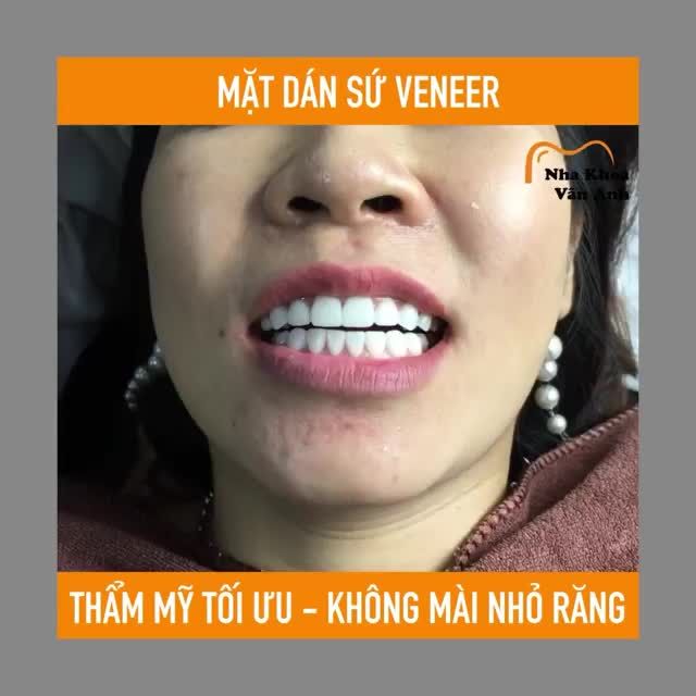 BẮC NINH MẶT DÁN SỨ VENEER - GIẢM NGAY 20%