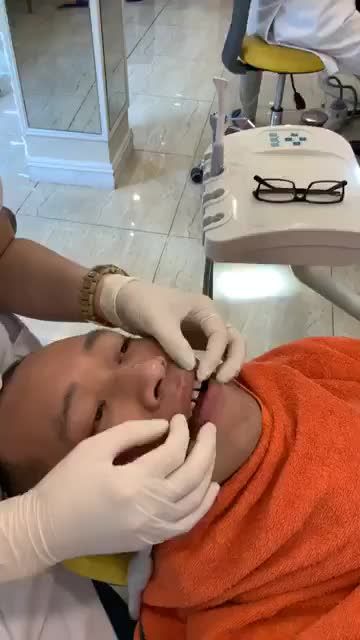 Ca bọc sứ 10 răng hàm trên, vị khách đến từ nam định ạ