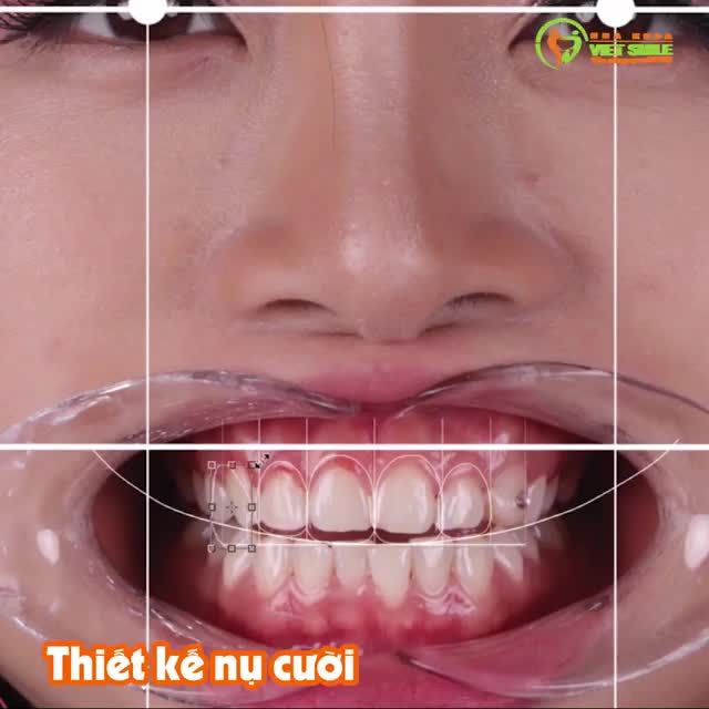 CẬN CẢNH VENEER LAMINATE SIÊU MỎNG TẠI VIET SMILE