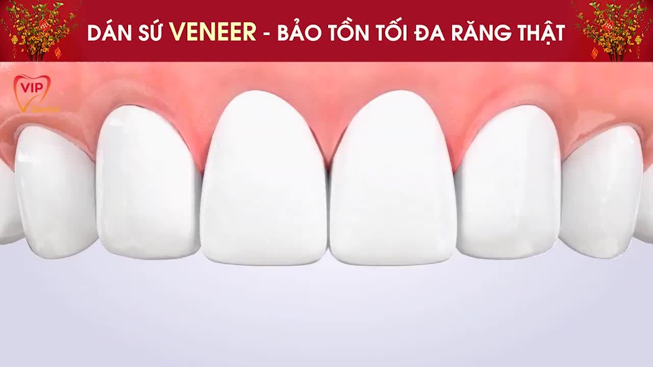 DÁN SỨ VENEER - BẢO TỒN TỐI ĐA RĂNG THẬT