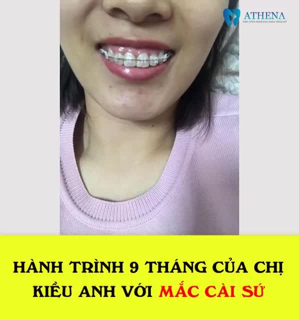 Nói đến niềng răng lúc đầu ai cũng ngại, cũng sợ nhưng sau khi niềng thì chưa một ai hối hận cả.