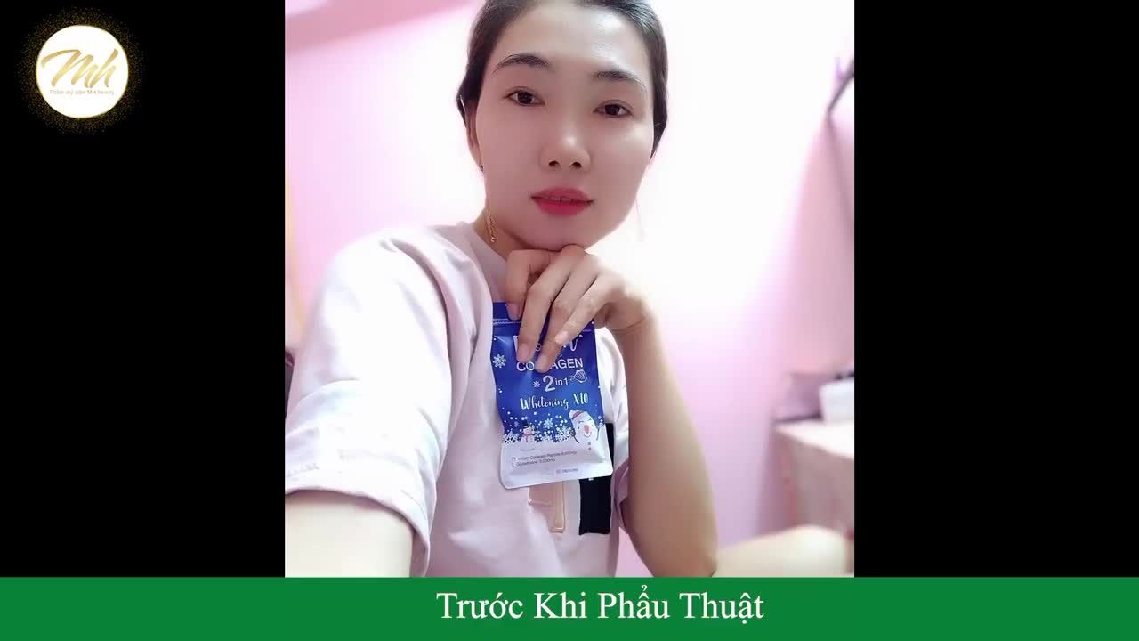 QUAY GÓC NÀO LÀ VÀO GÓC ĐẤY KHÁCH HÀNG SAU 3thang PHẨU THUẬT