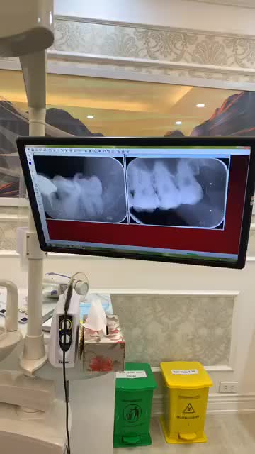 BIẾN CHỨNG ... KHI KHÔNG NHỔ RĂNG KHÔN SỚM .