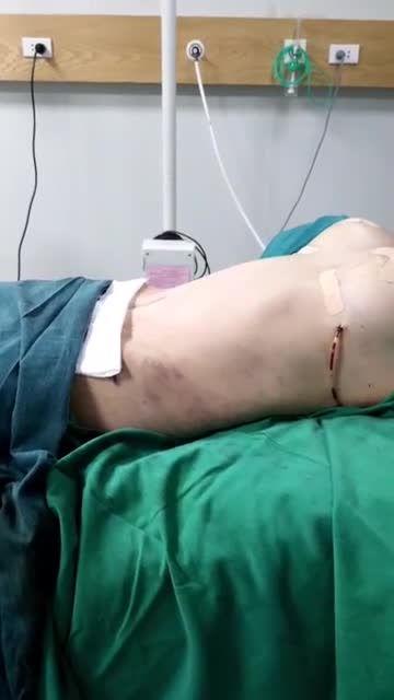 Kết quả ca siêu combo của ekip phẫu thuật DR.Vũ Quang!
